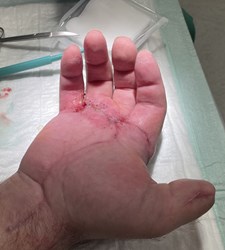 Hand nach OP