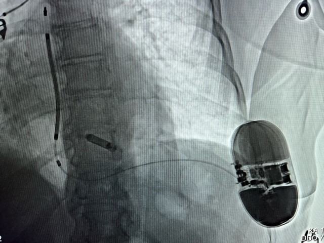 Sondenloser Schrittmacher