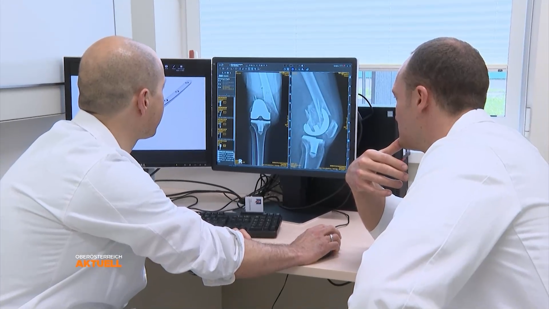 Verbesserung der Knochenheilung durch Hightech-Implantate bei Knochenbrüchen