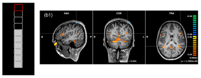 Regulierung von Gehirnaktivität mit Hilfe von real-time fMRI (2024)