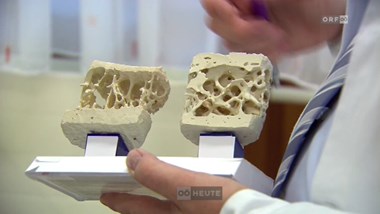 Volkskrankheit Osteoporose: Experten empfehlen möglichst frühzeitige Behandlung