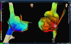 Virtuelles Modell des rechten Herzvorhofs, das bei einer strahlungsfreien Untersuchung (zero fluoro) im Zuge der Verödung von Vorhofflattern 