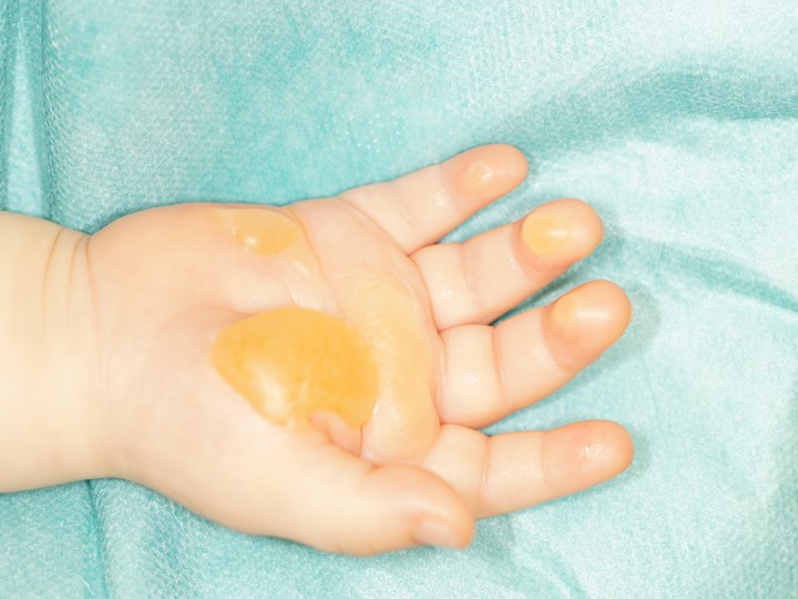 Kinderhand mit Verbrühungsblasen