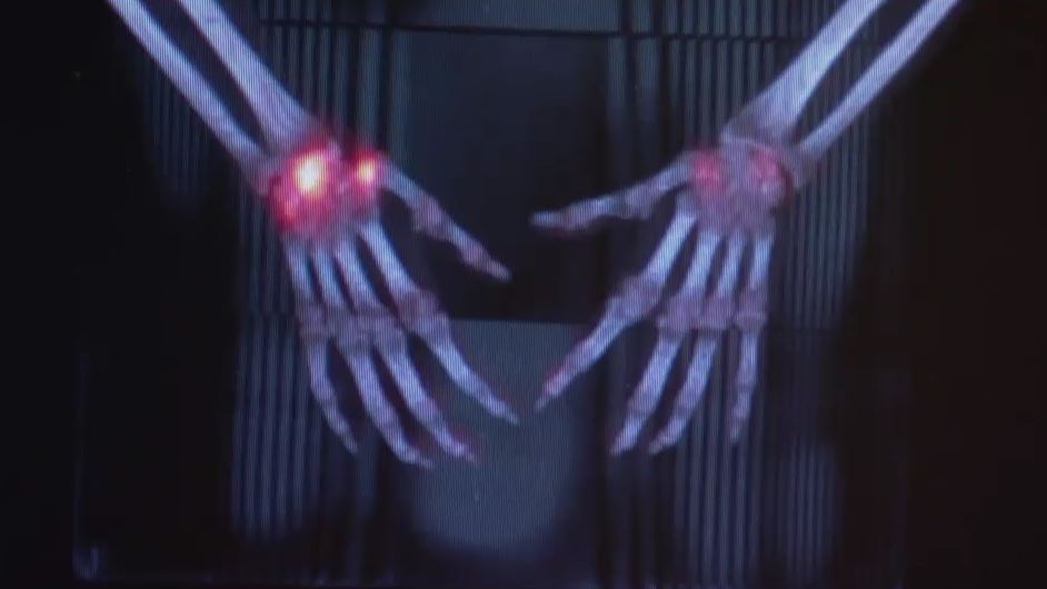 Erfolgreicher Einsatz der Radiosynoviorthese als neue Therapiemethode bei Rheuma