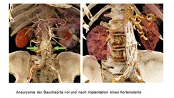 Aneurysma der Bauchaorta