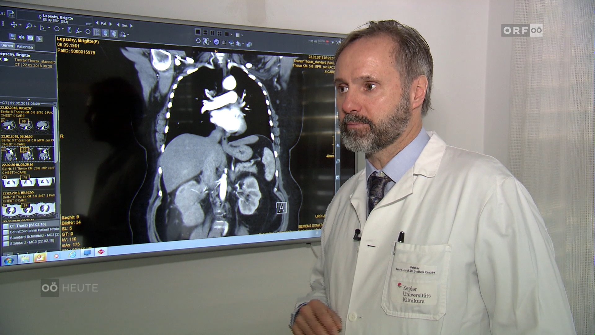 Immuntherapie bringt neue Hoffnung für Patientinnen und Patienten mit Nierenkrebs