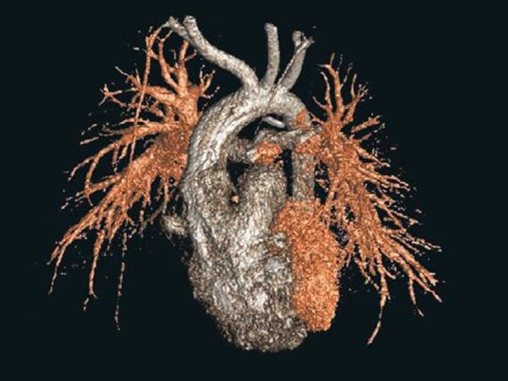 Grafische Darstellung eines Herzens mit Gefäßen