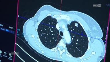 Lebensrettende Screening-Untersuchung bei Lungenkrebsrisiko